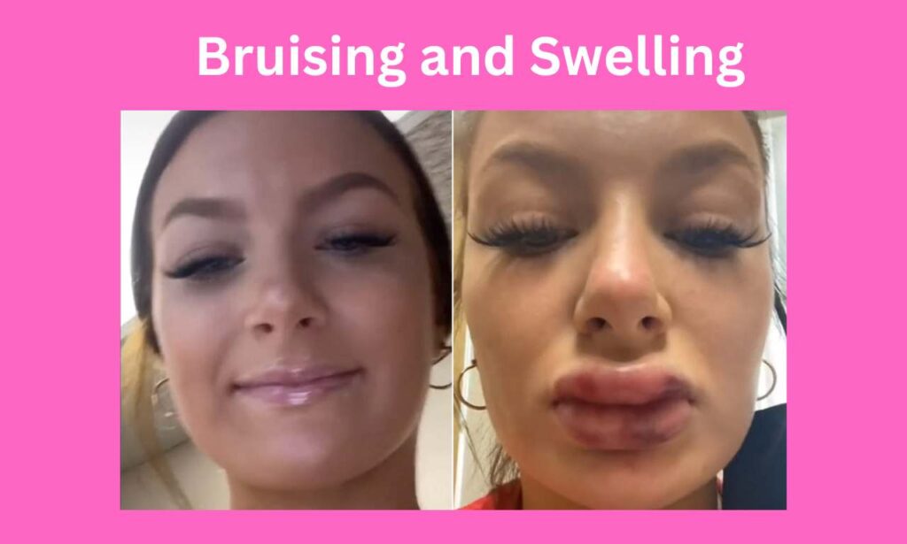 Bruising and Swelling a women effected shown in image.