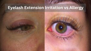 Eyelash Extension Irritation vs Allergy