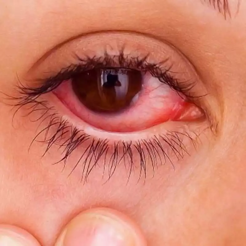 eyelash extension allergy