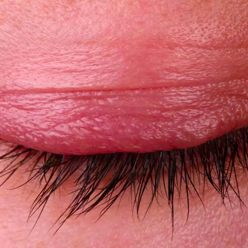 Eyelash Extension Irritation